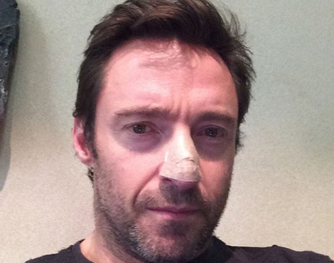 Hugh Jackman a un cancer de la peau