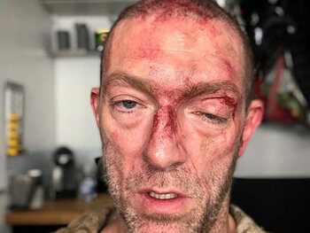 Qu'est-il arrivé à Vincent Cassel ?